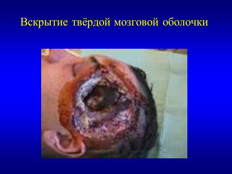 Вскрытие твёрдой мозговой оболочки